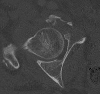 Acetabular Fracture Anterior Wall